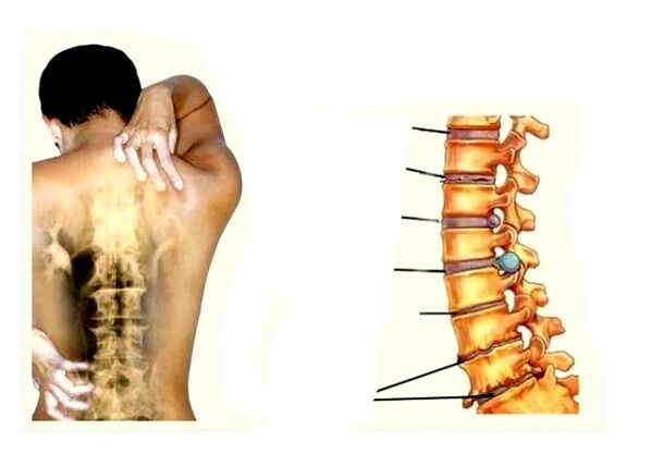 Etapy rozwoju osteochondozy