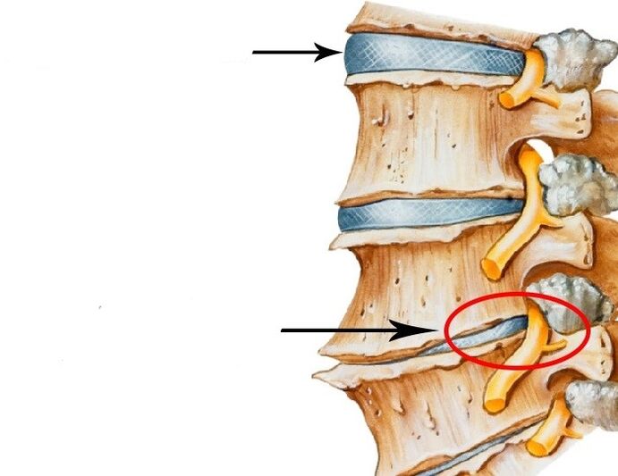 uszkodzony dysk i naruszenie nerwu z osteochondrozą szyjki macicy