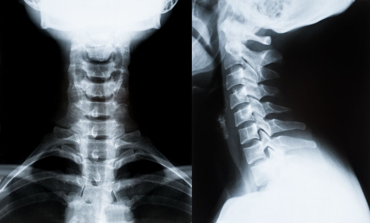 osteochondroza szyjna na zdjęciu rentgenowskim